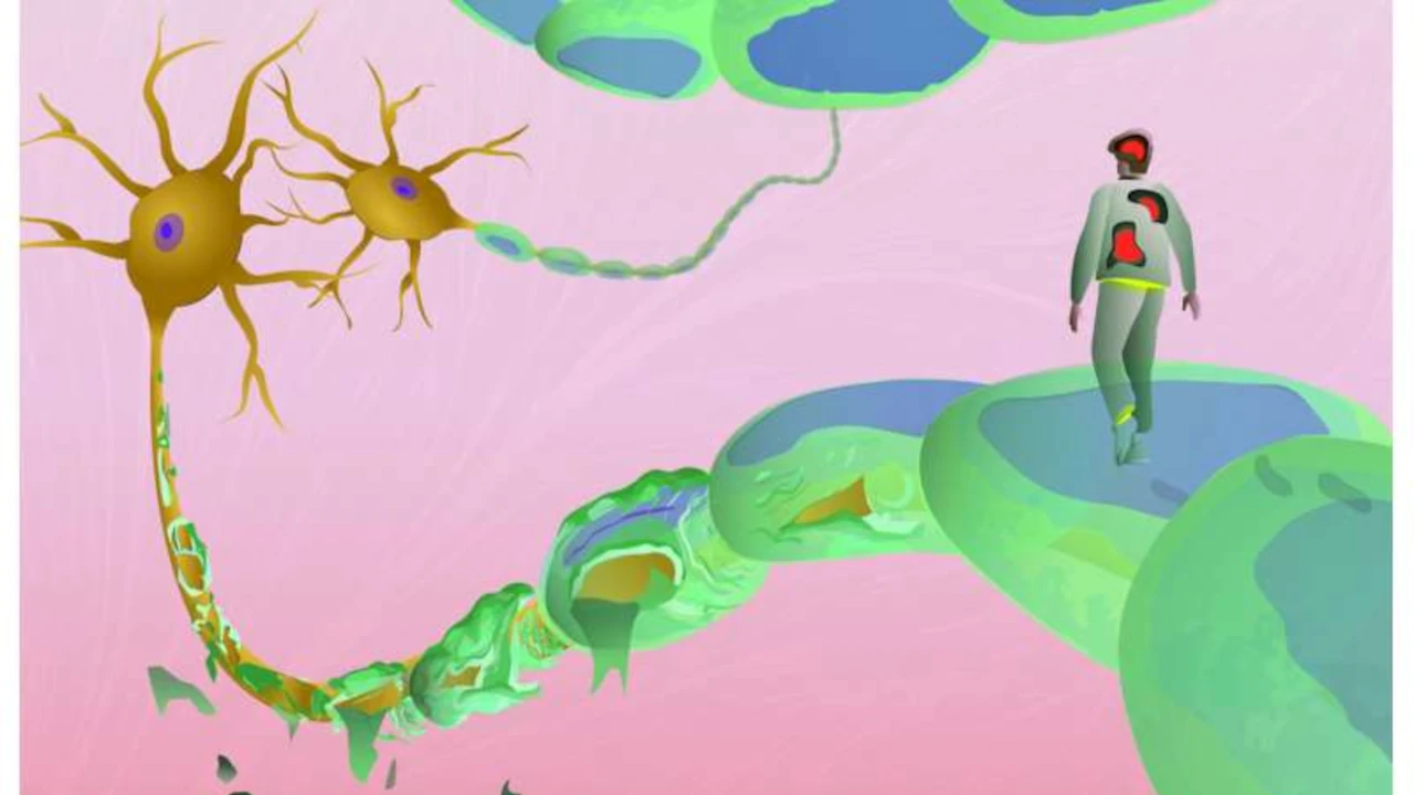 بیماری ام اس