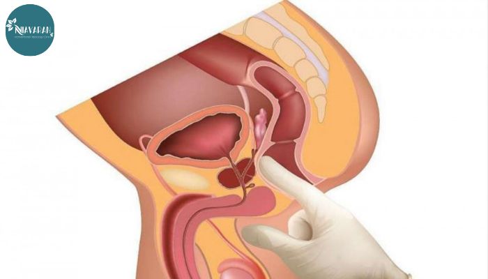 معاینه پروستات توسط پزشک با انگشت از طریق مقعد