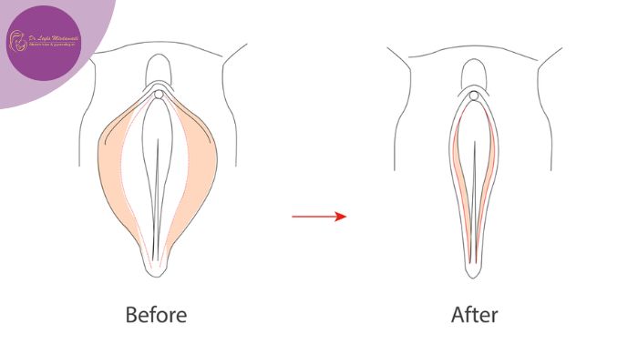 دلایل بروز عفونت پس از لابیاپلاستی