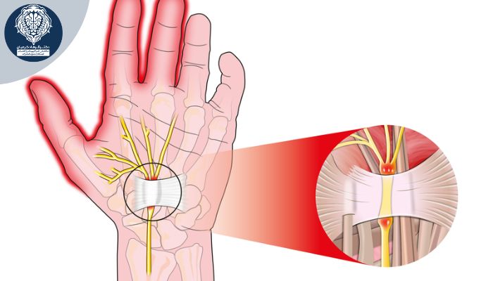 علائم هشداردهنده که نشان میدهد عصب دست تحت فشار است 2 مهمترین علائم اولیه فشار روی عصب دست