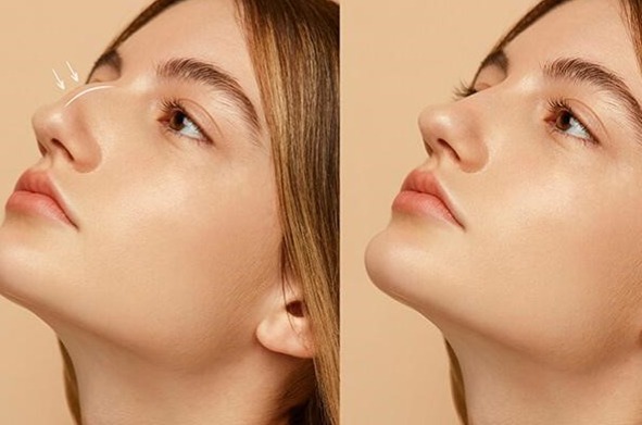 بررسی روش‌های رفع قوز بینی